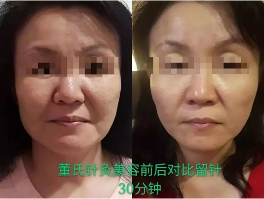 董氏奇穴正脉，经久不衰，带您重返人生！