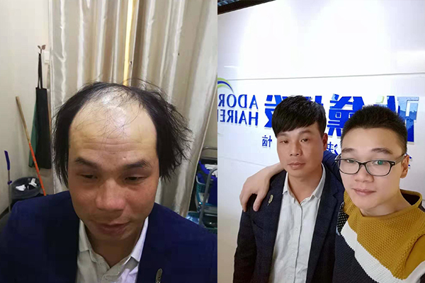 福州隐形补发 福州隐形补发