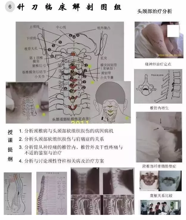 【针刀培训班】针刀临床解剖图干货知识赶快收了