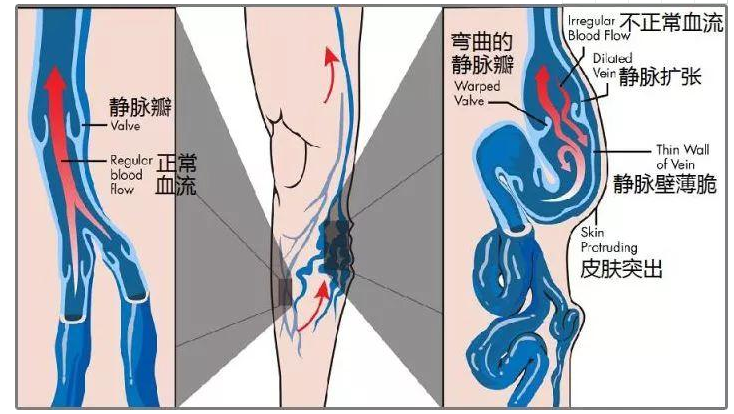 静脉曲张做了手术后还会继续复发吗？