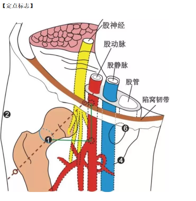 股骨头坏死的针刀精要