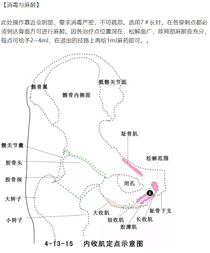 股骨头坏死的针刀精要