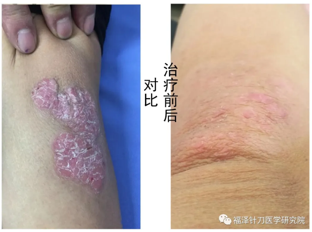 【5月15日大连市】针刀培训班——疑难问题杂症专题讲座线下推广公益性班