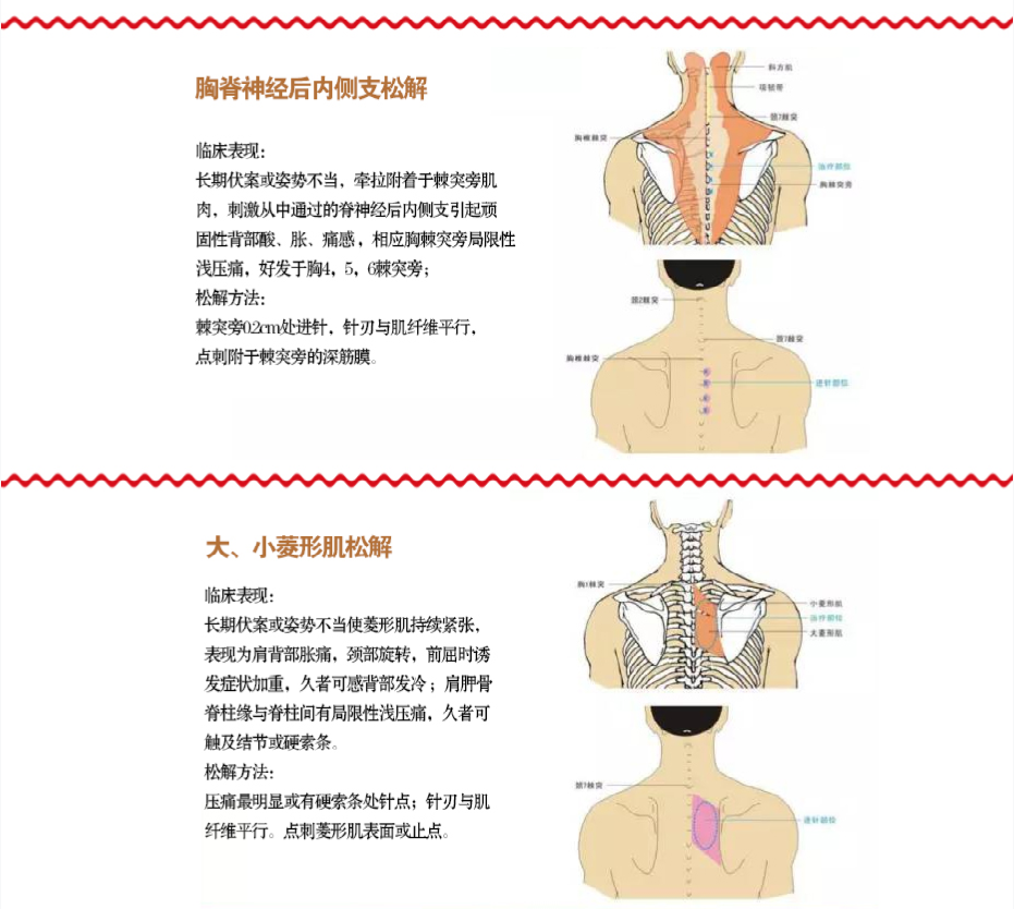想要了解针刀松解的方法吗？下面有全图解，联系龙老师还送视频课程哦！！