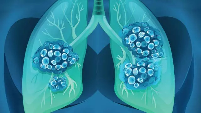 肺部鳞癌晚期能活几年_肺部鳞癌_肺部鳞癌和腺癌哪个复发率高