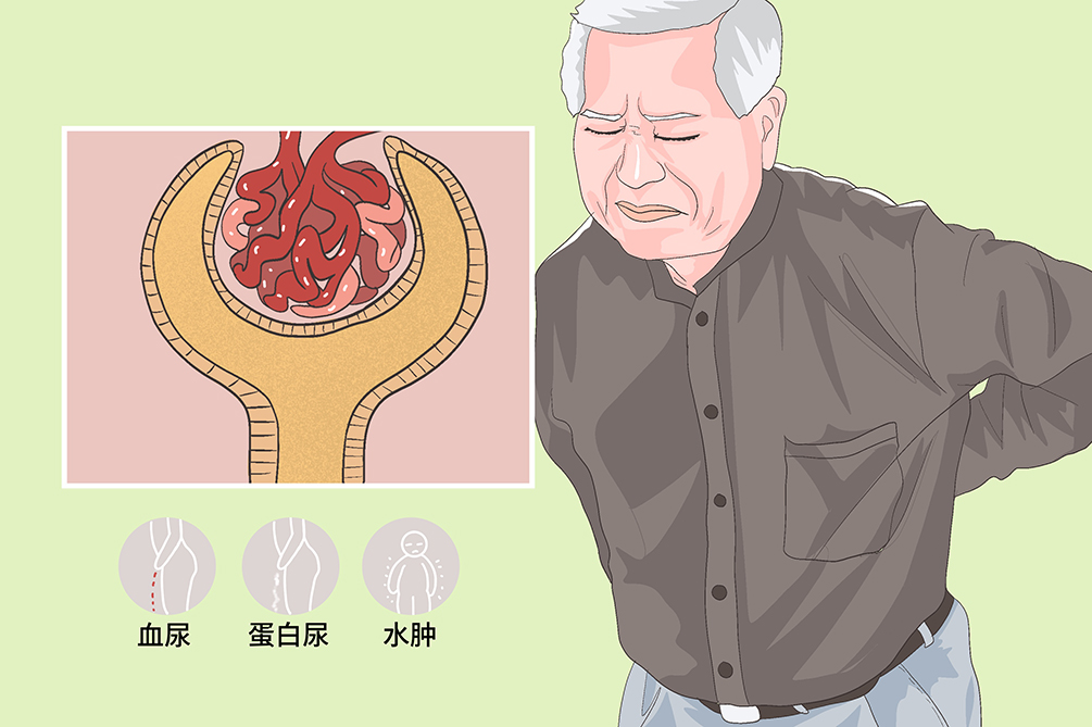 慢性肾小球肾炎