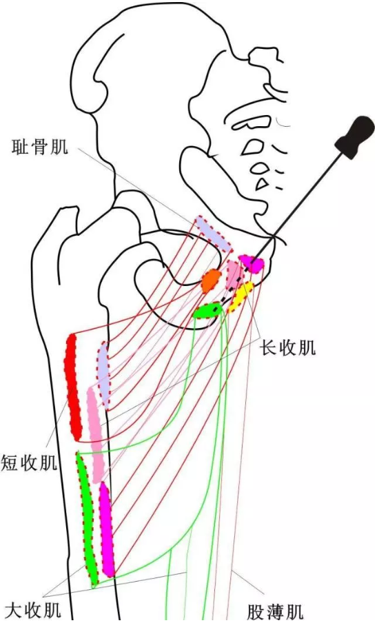 股骨头坏死的针刀精要