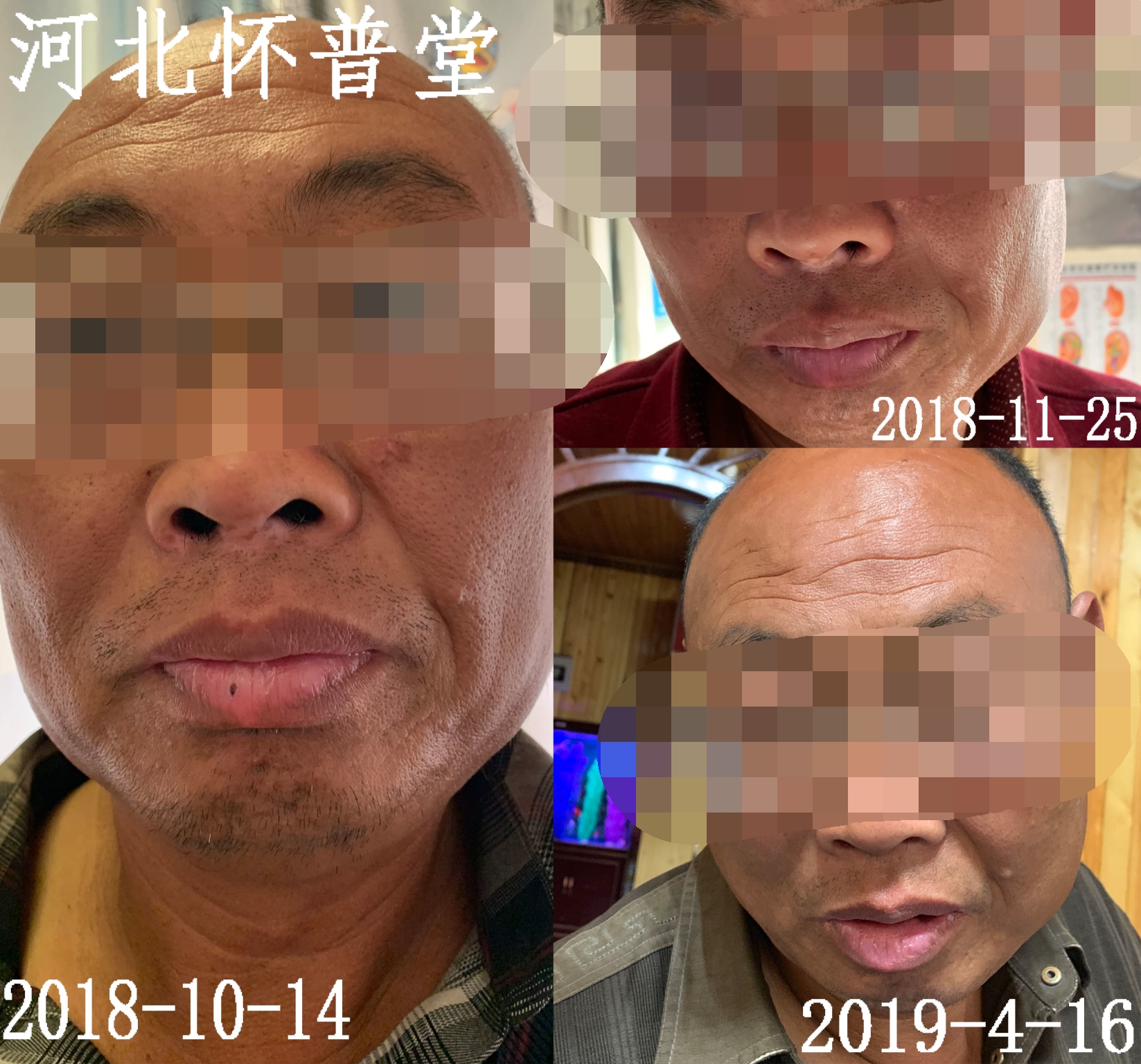 白癜风效果
