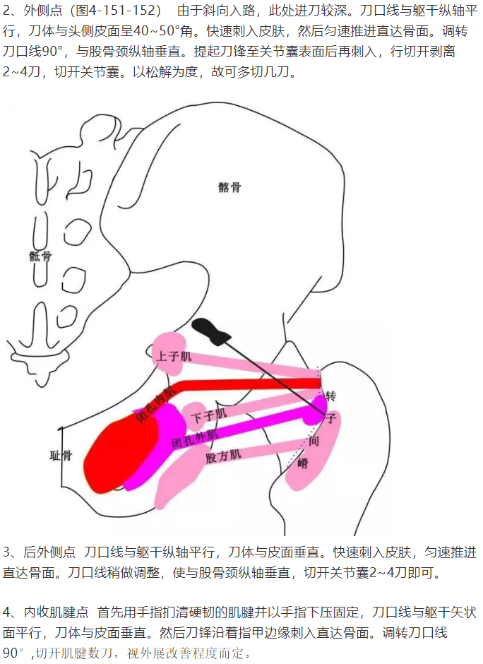 股骨头坏死的针刀精要