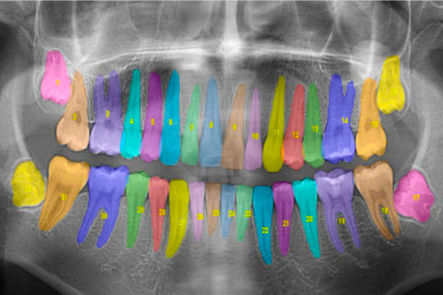 麻省理工學院:用人工智能消除牙科護理中的猜測