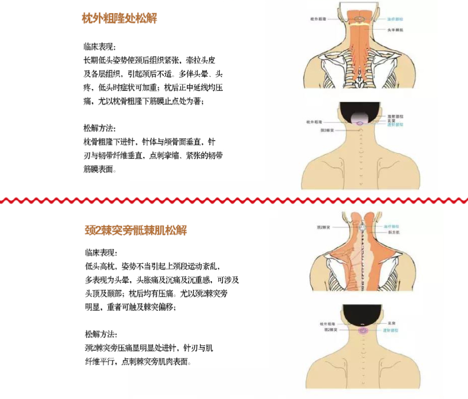 想要了解针刀松解的方法吗？下面有全图解，联系龙老师还送视频课程哦！！