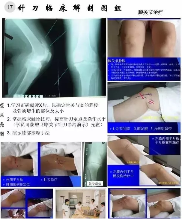 【针刀培训班】针刀临床解剖图干货知识赶快收了
