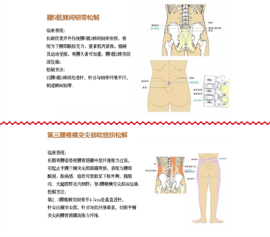 想要了解针刀松解的方法吗？下面有全图解，联系龙老师还送视频课程哦！！