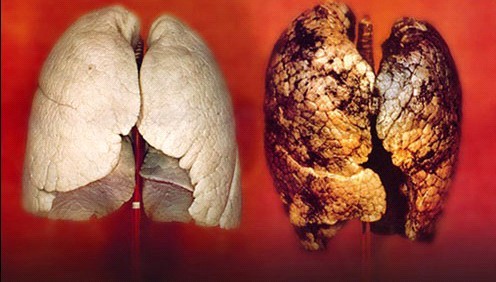 重庆针灸肺癌早期什么症状