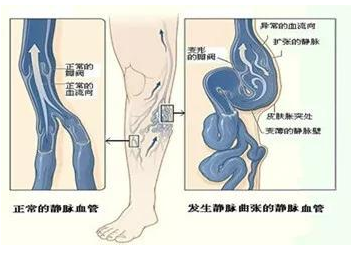 静脉曲张做了手术后还会继续复发吗？
