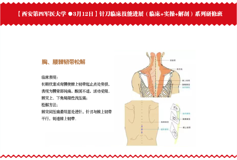 想要了解针刀松解的方法吗？下面有全图解，联系龙老师还送视频课程哦！！