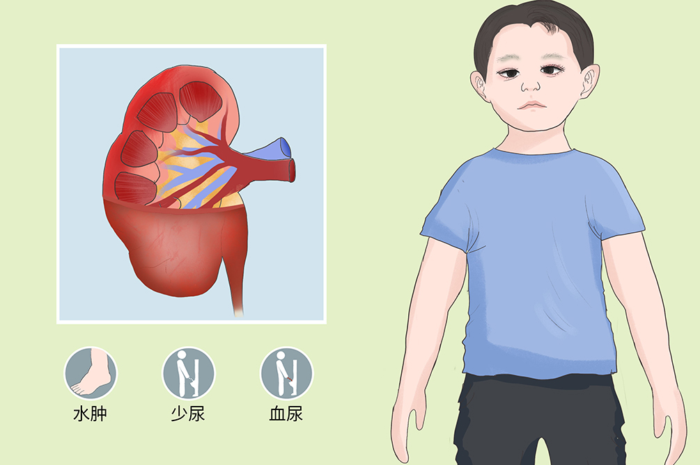 急性肾小球肾炎