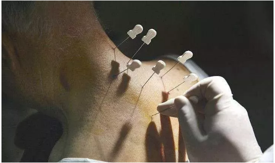 ​中医针灸的发源与发展趋势