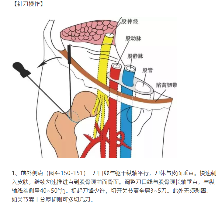 股骨头坏死的针刀精要