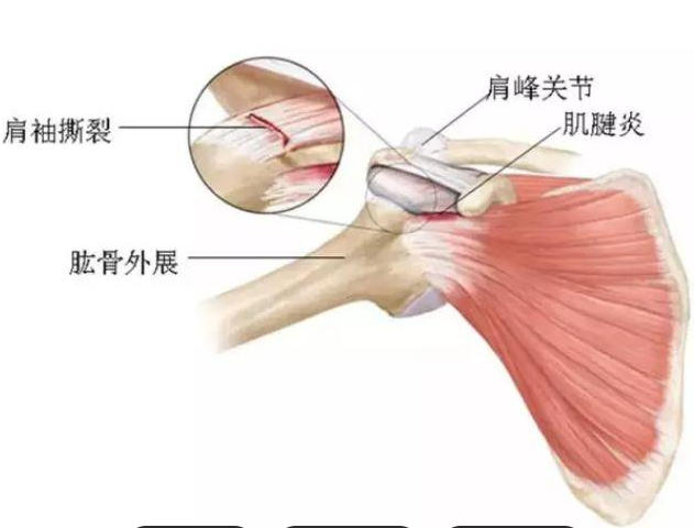 冈上肌肌腱炎临床诊断与