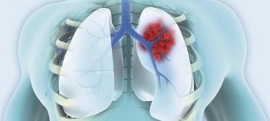 常州肺癌有什么症状