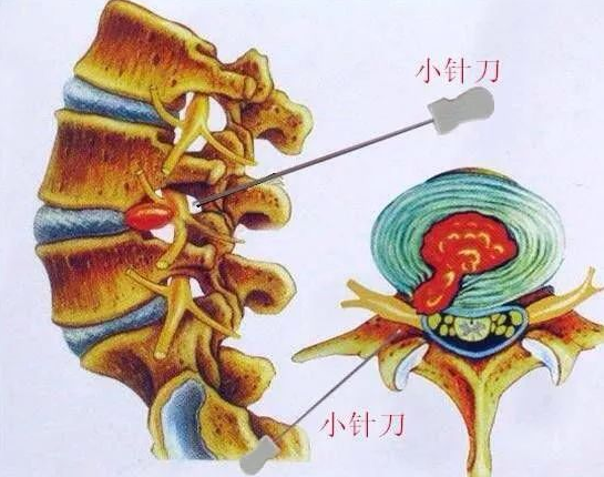 激光针刀松解术有什么作用？能够治什么病症？