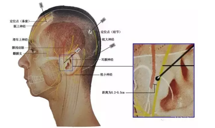 脑梗死糊涂能针灸吗?