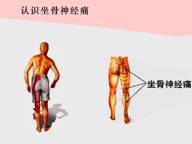 坐骨神經痛，這樣做你就舒服多了！