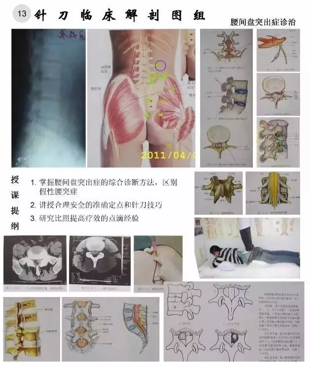 【针刀培训班】针刀临床解剖图干货知识赶快收了