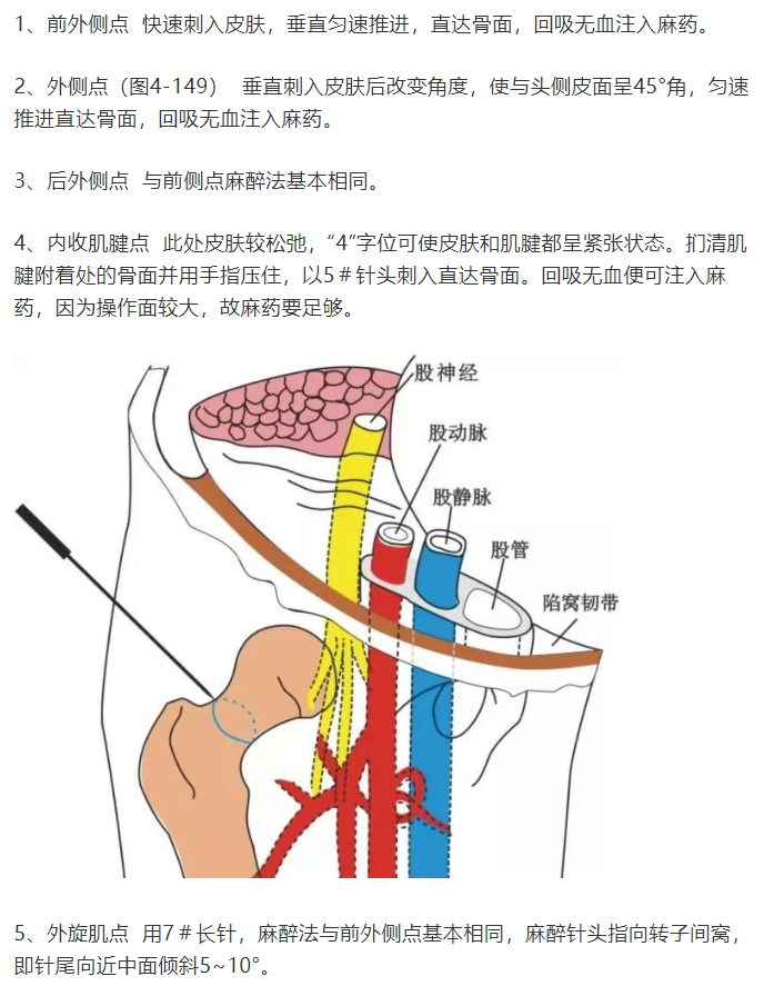 股骨头坏死的针刀精要