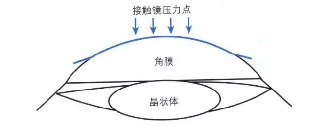 角膜塑形镜矫正青少年近视的优势