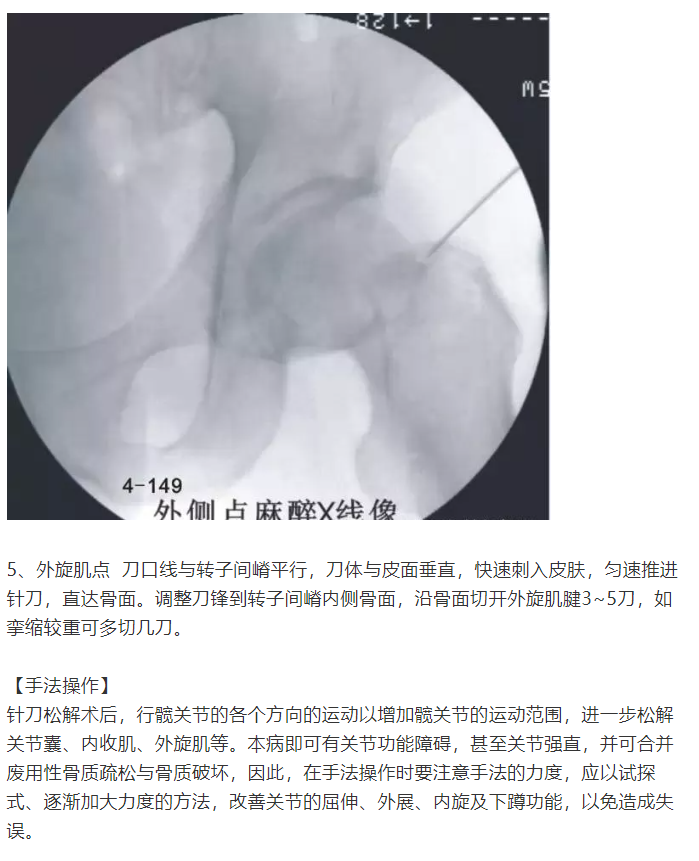 股骨头坏死的针刀精要