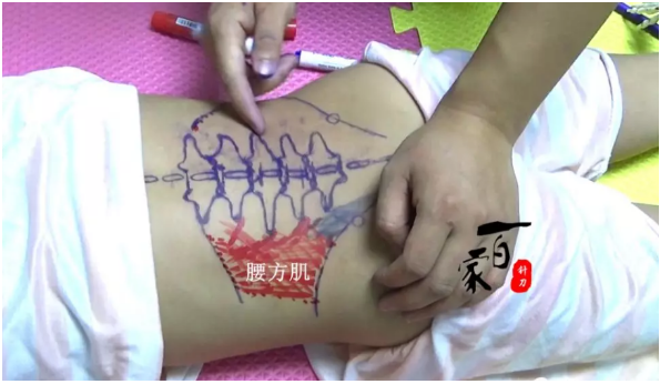 【针刀培训班】腰方肌与总体力线的关联