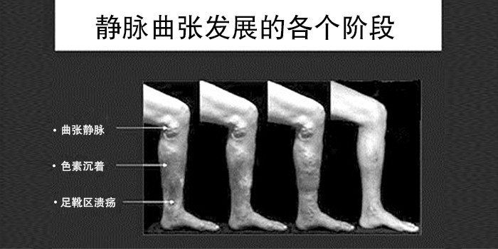 静脉曲张培训班哪里有？哪里有好的静脉曲张培训学习班？