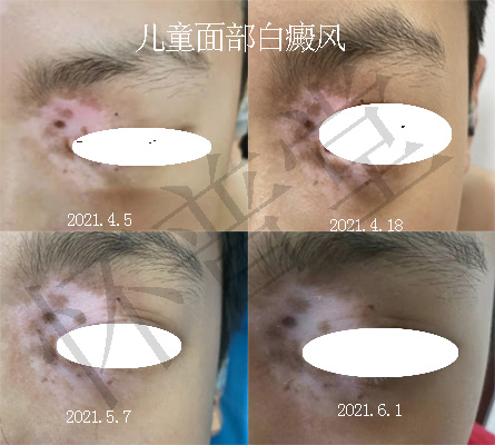 儿童面部白癜风