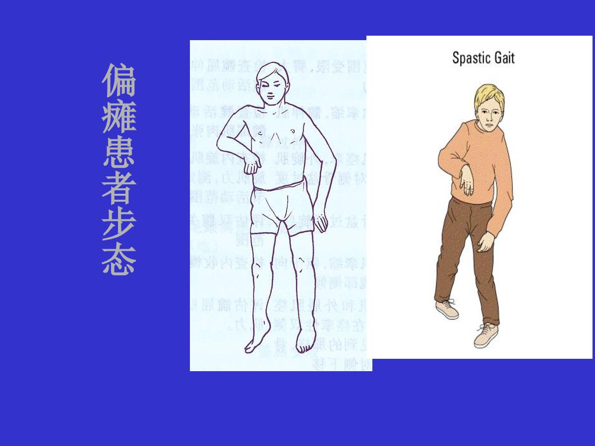 左云怎么治高血压中风什么引起的-临汾永旺脑病医院