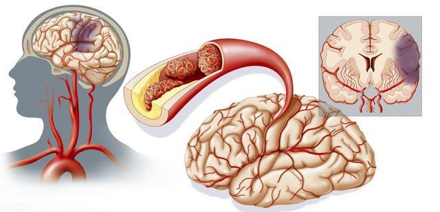 大名什麼是腔隙性腦梗塞早期症狀