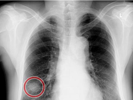 肺癌霍纳综合征图象图片