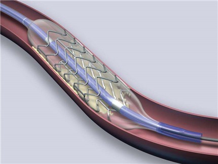 冠脉支架
