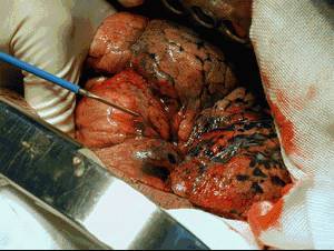 榆社非小细胞肺癌好的老中医